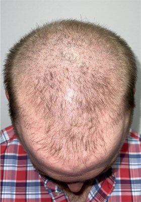 hair transplant photos