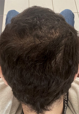 hair transplant before after Photos