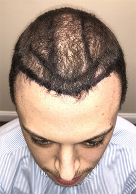 hair transplant photos