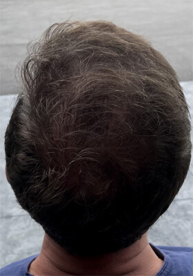 hair transplant before after Photos