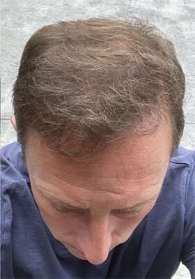 hair transplant photos