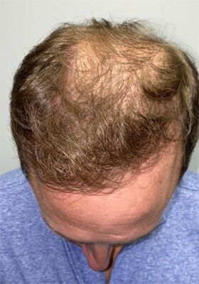 hair transplant photos