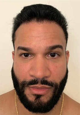 hair transplant photos