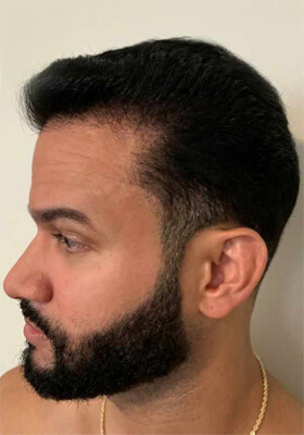 hair transplant before after Photos