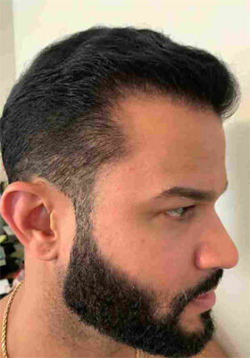 hair transplant before after Photos