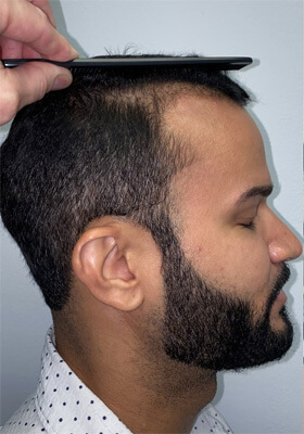 hair transplant photos