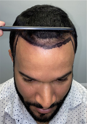 hair transplant before after Photos