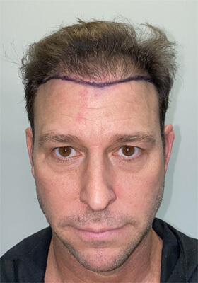 hair transplant photos