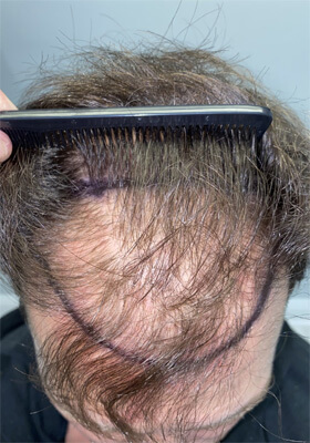 hair transplant photos