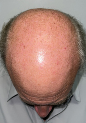 hair transplant photos