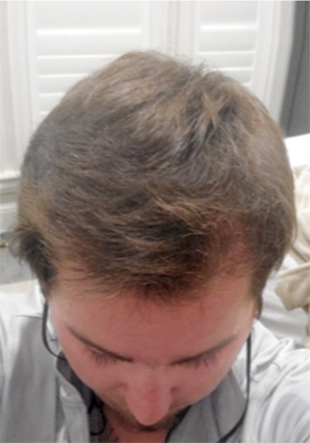 hair transplant photos