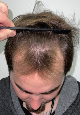 hair transplant photos