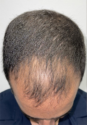 hair transplant photos