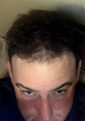 hair transplant photos