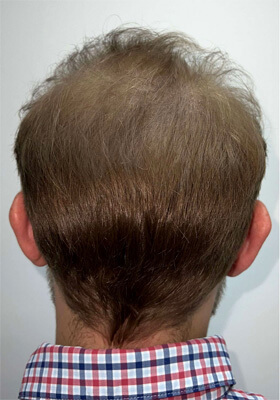 hair transplant photos