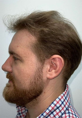 hair transplant photos