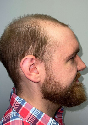 hair transplant photos