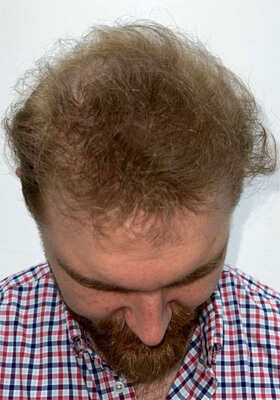 hair transplant photos