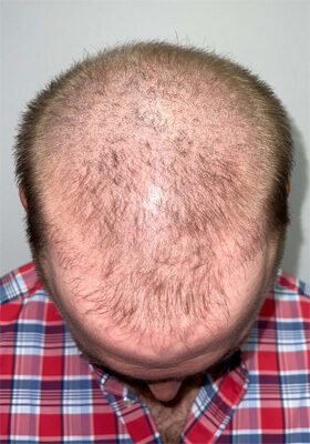 hair transplant photos