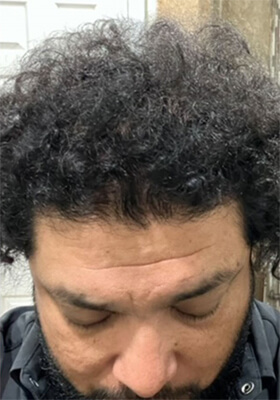 hair transplant before after Photos