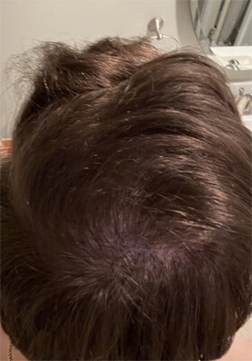 hair transplant before after Photos