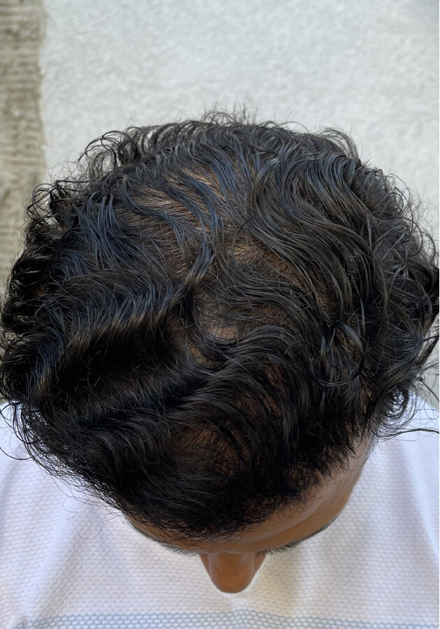 hair transplant photos