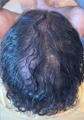 hair transplant photos