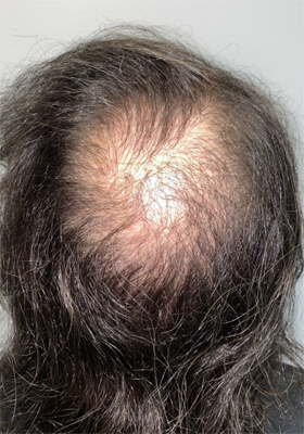 hair transplant photos