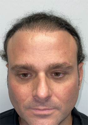 hair transplant before after Photos