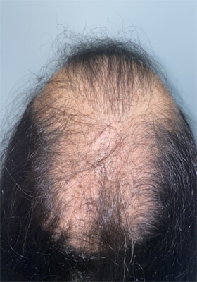 hair transplant before after Photos