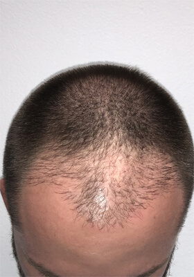 hair transplant before after Photos