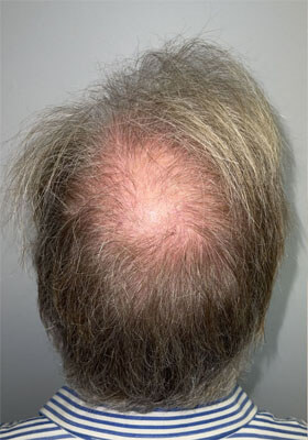 hair transplant photos