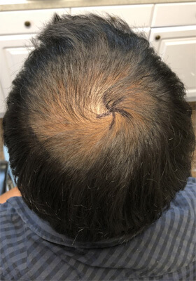 hair transplant photos