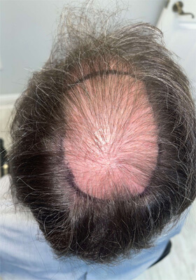 hair transplant photos