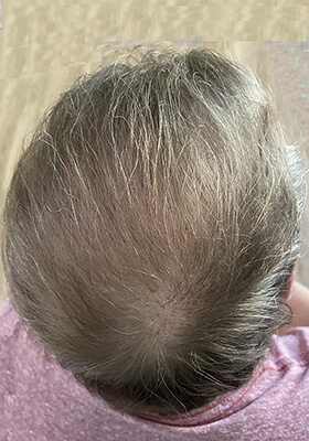 hair transplant photos