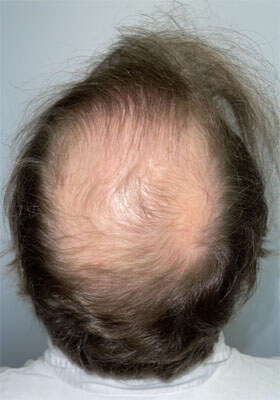 hair transplant photos