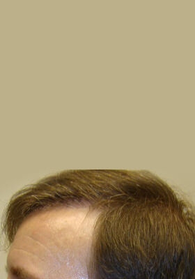 hair transplant before after Photos