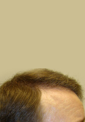 hair transplant photos