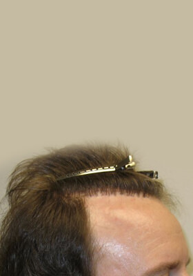 hair transplant photos