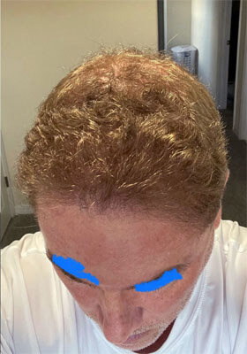 hair transplant photos