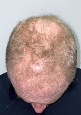 hair transplant before after Photos