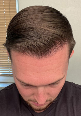 hair transplant photos