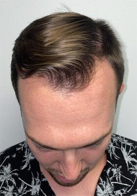 hair transplant photos