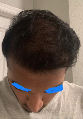 hair transplant photos