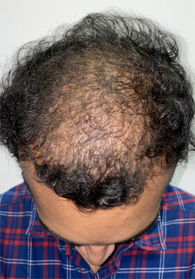 hair transplant before after Photos