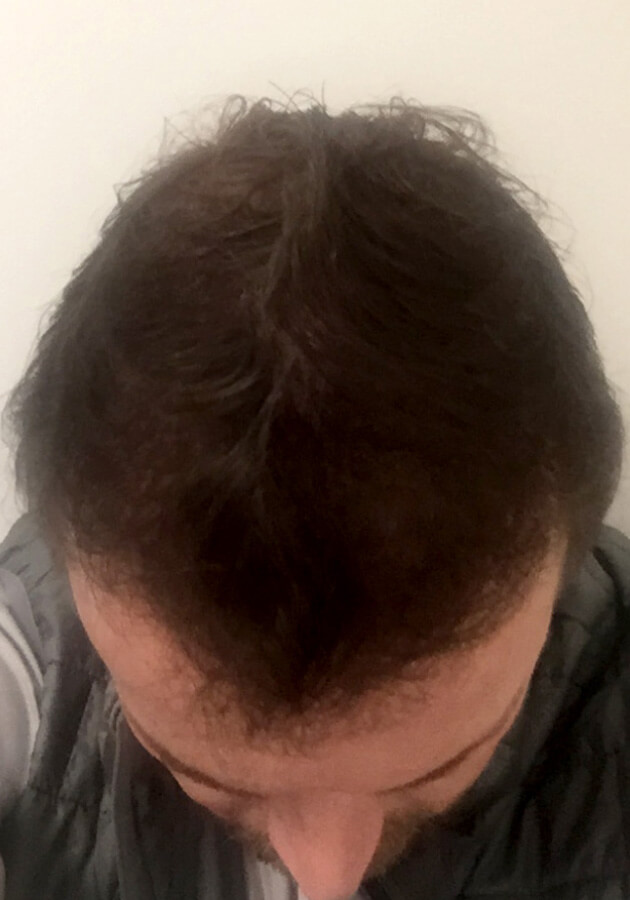 hair transplant before after Photos