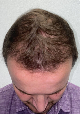 hair transplant photos