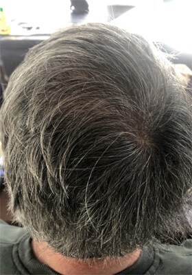 hair transplant photos