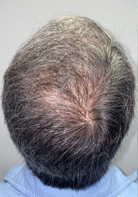 hair transplant photos