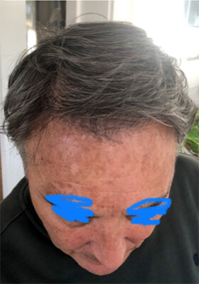 hair transplant photos